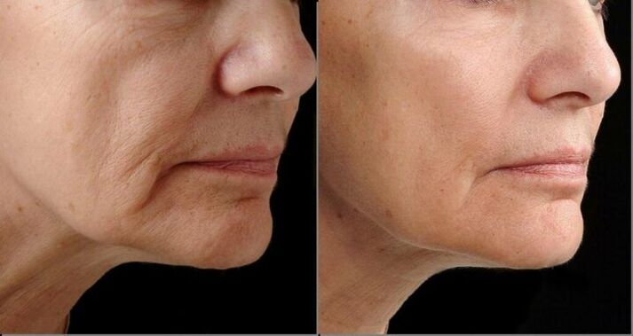 Кожата на лицето преди и след процедурата за подмладяване с лазер