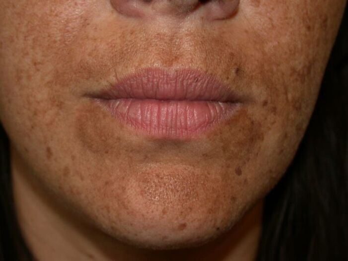 Пигментните петна по лицето са индикация за лазерна процедура