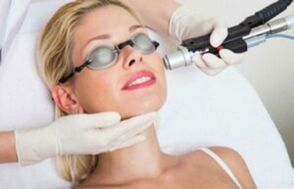 Процедура за подмладяване на кожата на лицето с лазер