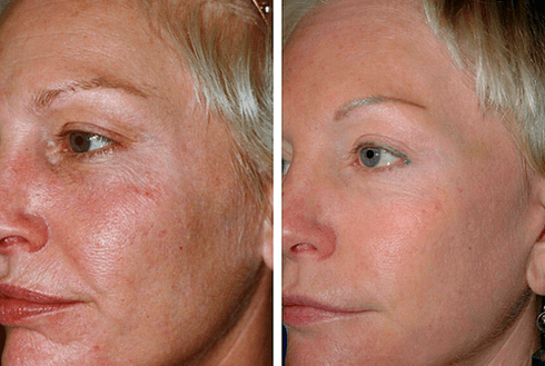 преди и след частично подмладяване на кожата снимка 1