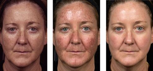 преди и след частично подмладяване на кожата снимка 2