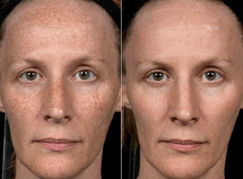 преди и след частично подмладяване на кожата снимка 3