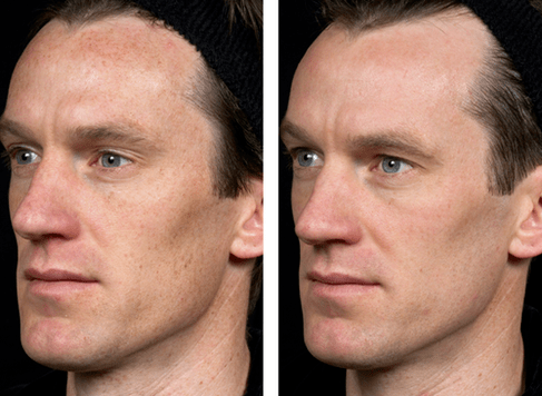 преди и след частично подмладяване на кожата снимка 5
