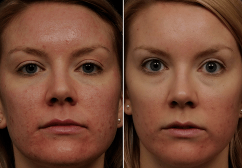 преди и след частично подмладяване на кожата снимка 6