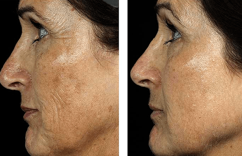 преди и след частично подмладяване на кожата снимка 7