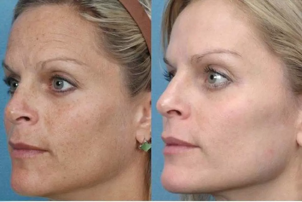 снимка преди и след апаратно подмладяване на кожата 1
