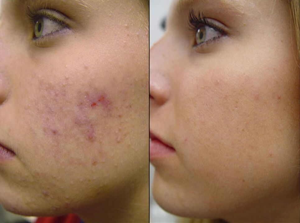 снимка преди и след апаратно подмладяване на кожата 2