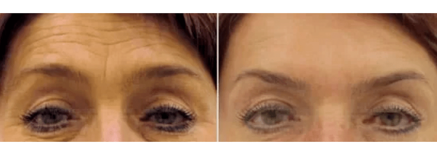 апарати за фракционно подмладяване