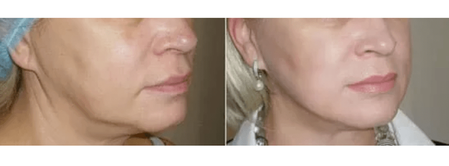 възстановяване след подмладяване на кожата